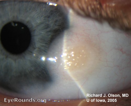 Goldenhar Syndrome Spectrum | Hereditary Ocular Diseases